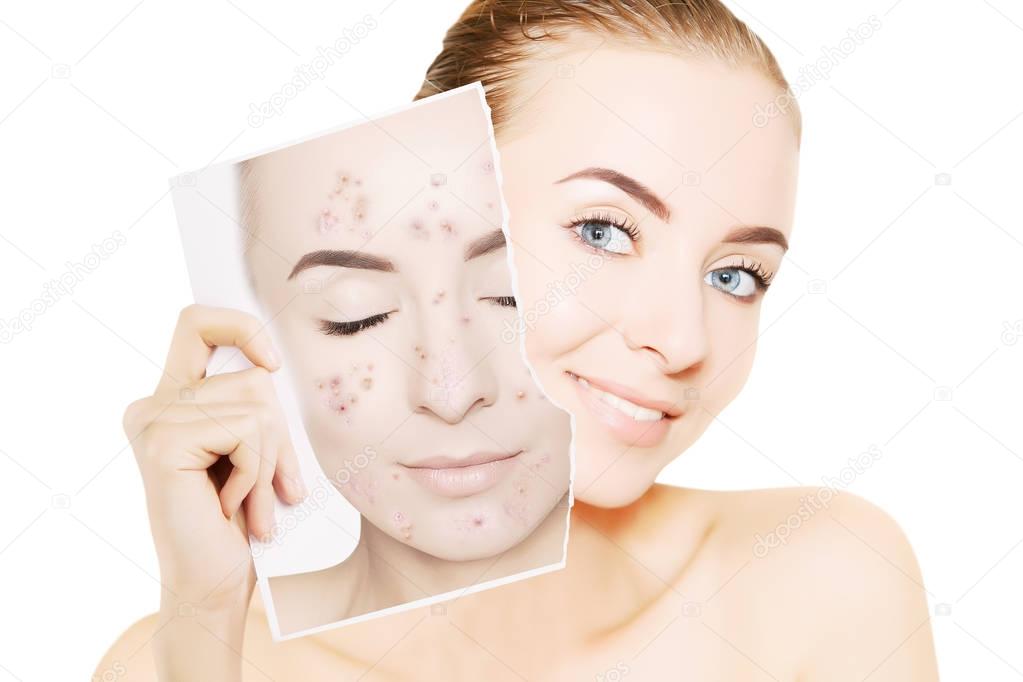 woman with perfect skin releases her face from pimples