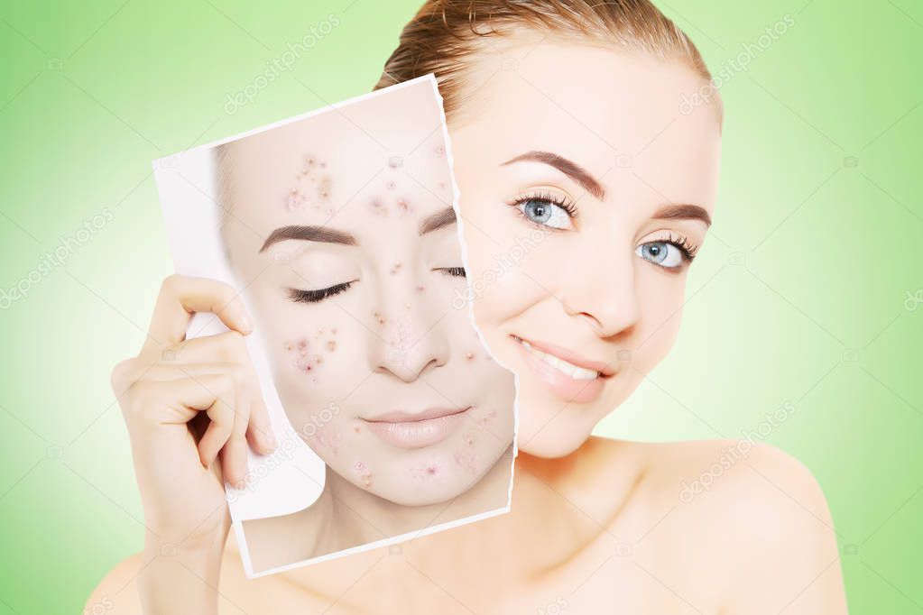 young  woman with perfect skin releases her face from pimples