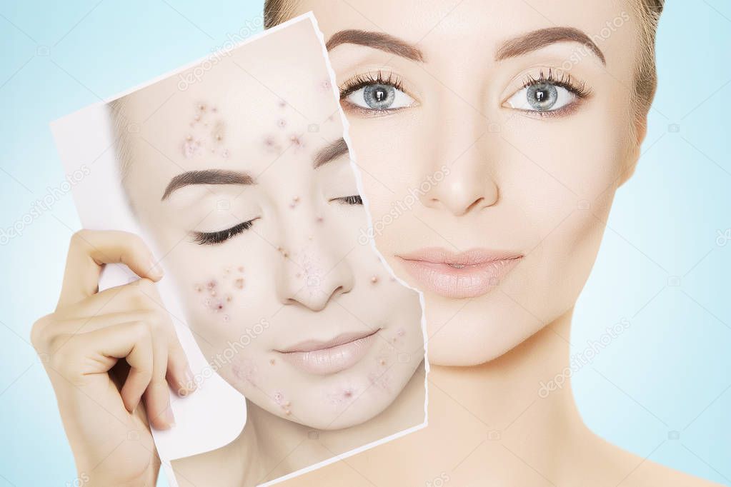 gorgeous woman with perfect skin releases her face from pimples