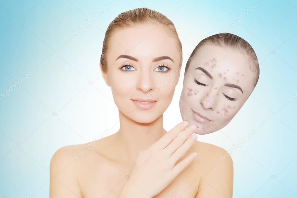 woman takes away mask with acne and pimples,blue background