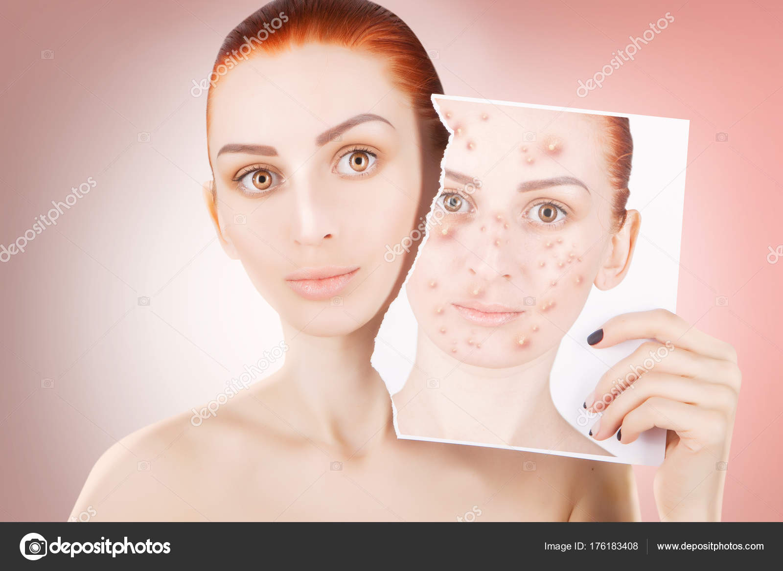 acne problemen acne problemen
