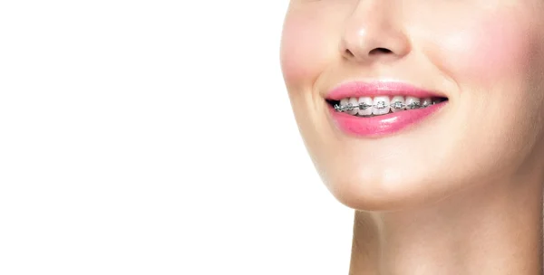 Bella giovane donna con denti bretelle — Foto Stock