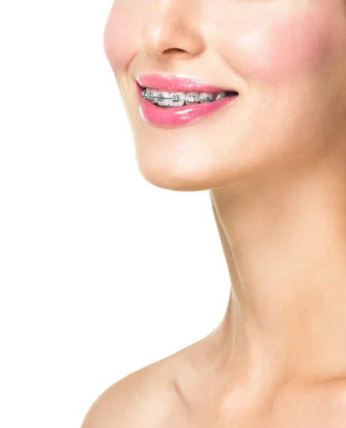 Vacker ung kvinna med tänder hängslen — Stockfoto