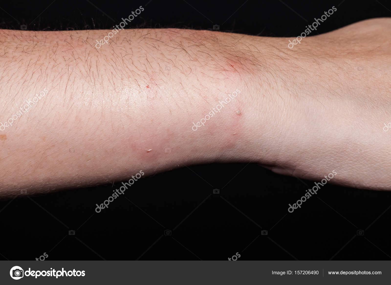 Dog bite wound and scar with dark background Stock Photo by