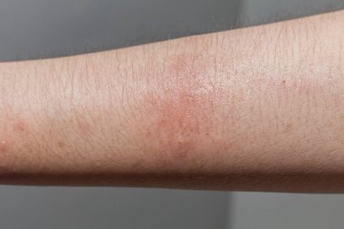 Köpek ısırması yarası ve karanlık arka planda yara