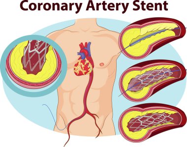 Koroner arter stent vektör çizim