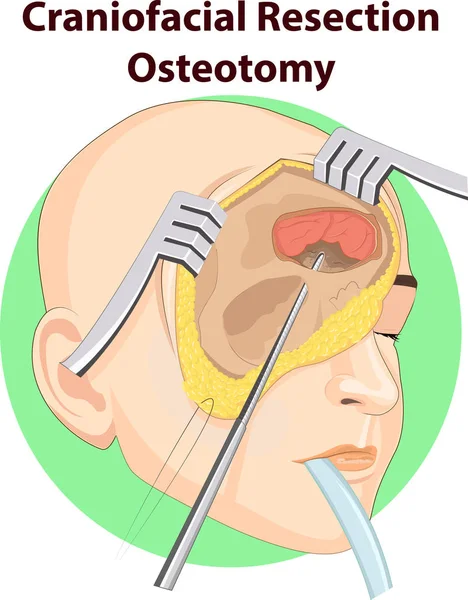 Ilustração Vetorial Anatomia Cirurgia Crânio —  Vetores de Stock