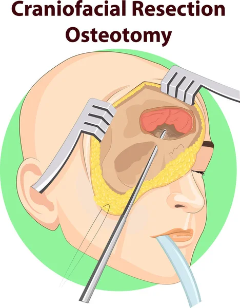 Ilustración Vectorial Anatomía Cirugía Craneal — Vector de stock