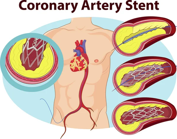 Koroner arter stent vektör çizim