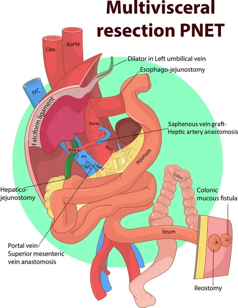 Vektorillustration Der Intestinalen Und Multivisceralen Anatomie — Stockvektor