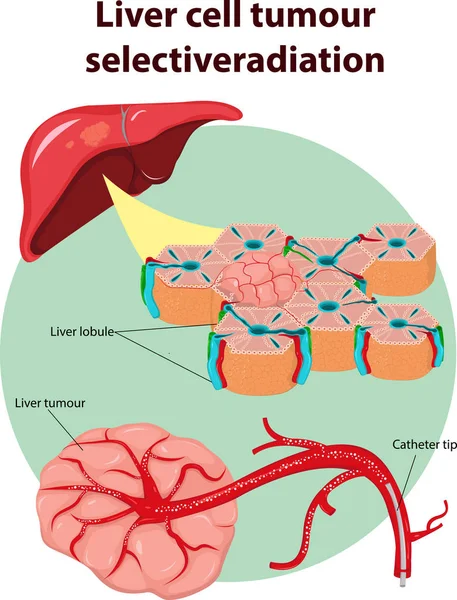 Illustrazione Vettoriale Dell Anatomia Selettiva Del Tumore Epatico — Vettoriale Stock