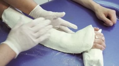 Doktor düzgünleştirir dışarı Travmatoloji bölümü hastada kol üzerinde bandaj alçı.