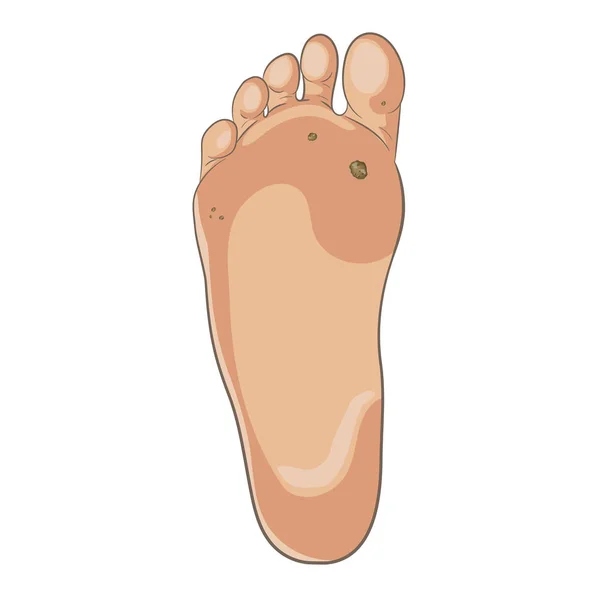 Foot wart. Foot bottom pathology — Stock Vector