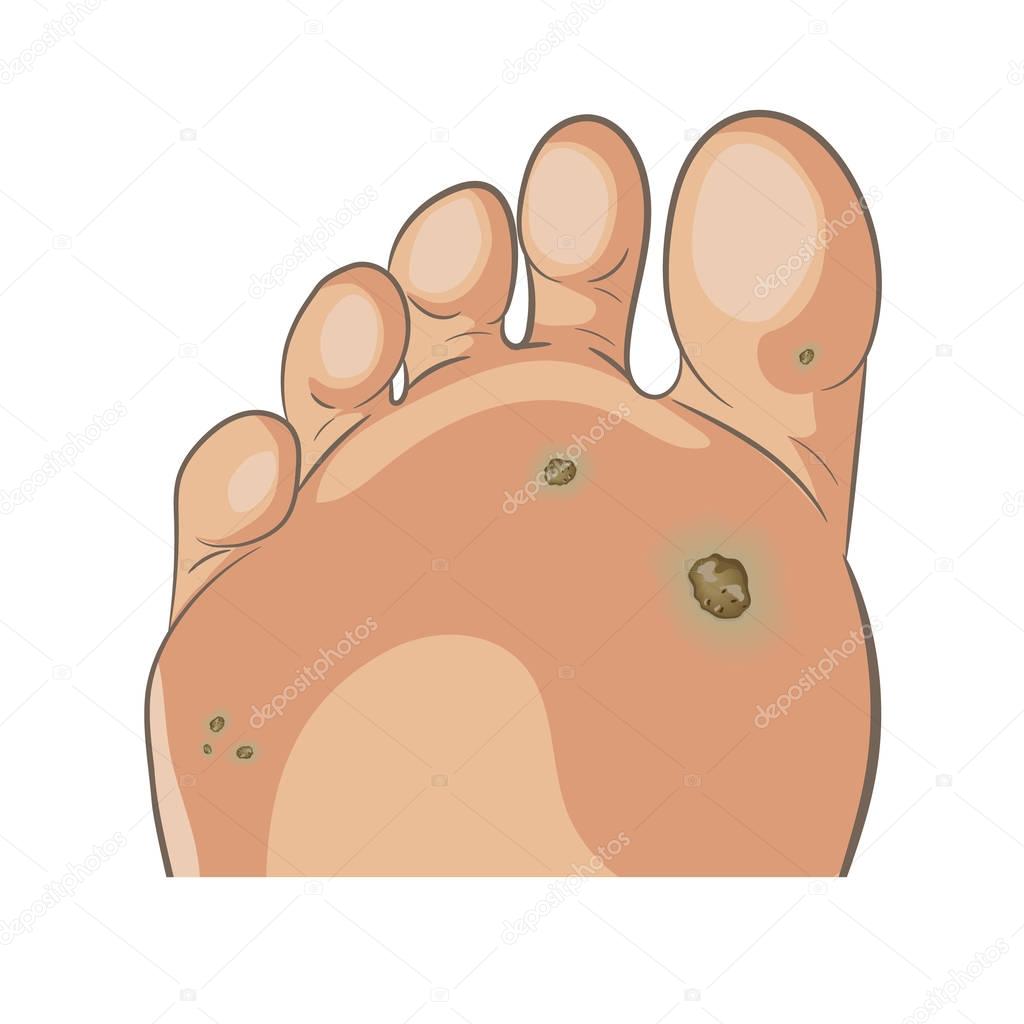 Foot wart. Foot bottom pathology