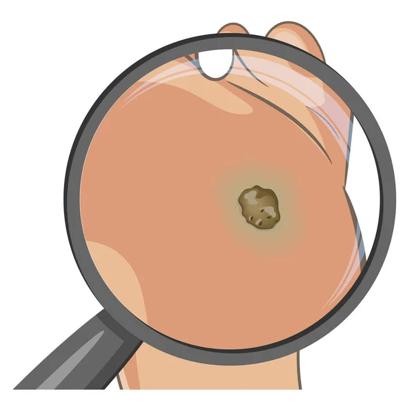 Foot wart magnified with glass. — Stock Vector