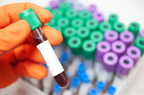 Doktor 2019 nCoV analizi için test tüpünü kanla tutuyor. Çin Koronavirüsü kan testi konsepti. Kan testi.. 