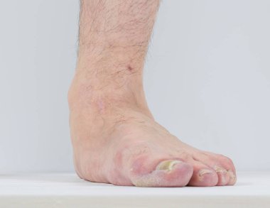 Erkekler aynasız belirtileri ile ayak ve tırnak mantar.