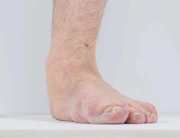 Men with signs of flatfoot foot and nail fungus. — Stock Photo, Image