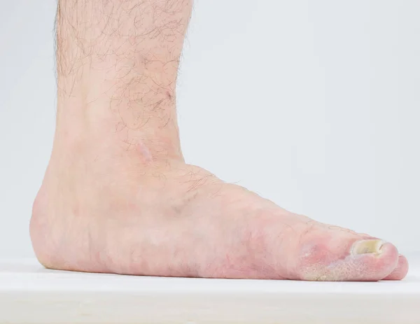 Düz ayak ve mantar hastalıkları tezahürü.