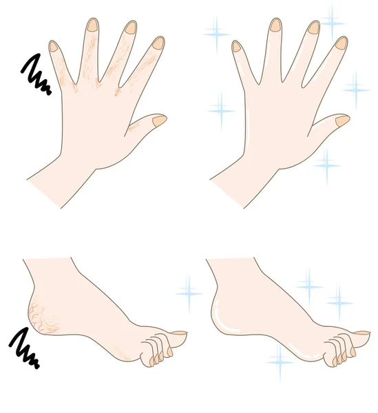 Τραχύ δέρμα χέρι και πόδι — Διανυσματικό Αρχείο