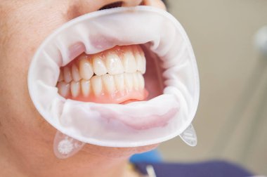 Takma dişler. Dişlerin yakın fotoğrafını çek. Teşhis ve eşödeme