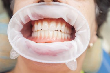 Takma dişler. Dişlerin yakın fotoğrafını çek. Teşhis ve eşödeme