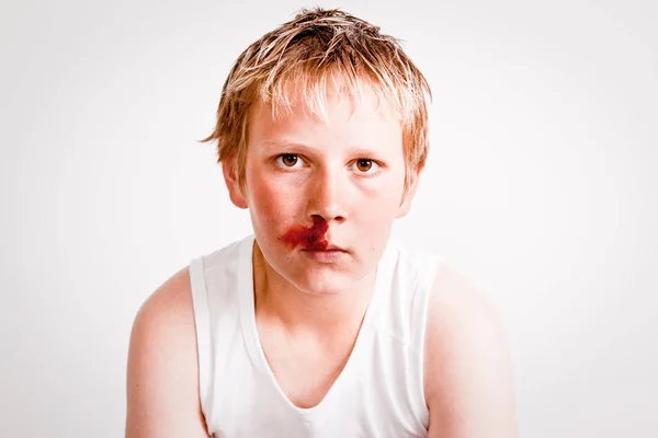 Teenage boy with a nosebleed — Stock Photo, Image
