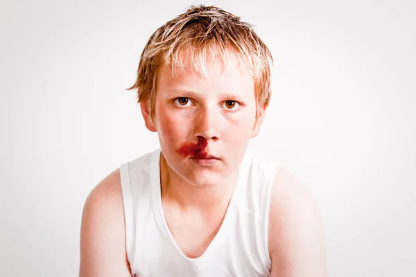 Adolescente con una hemorragia nasal —  Fotos de Stock