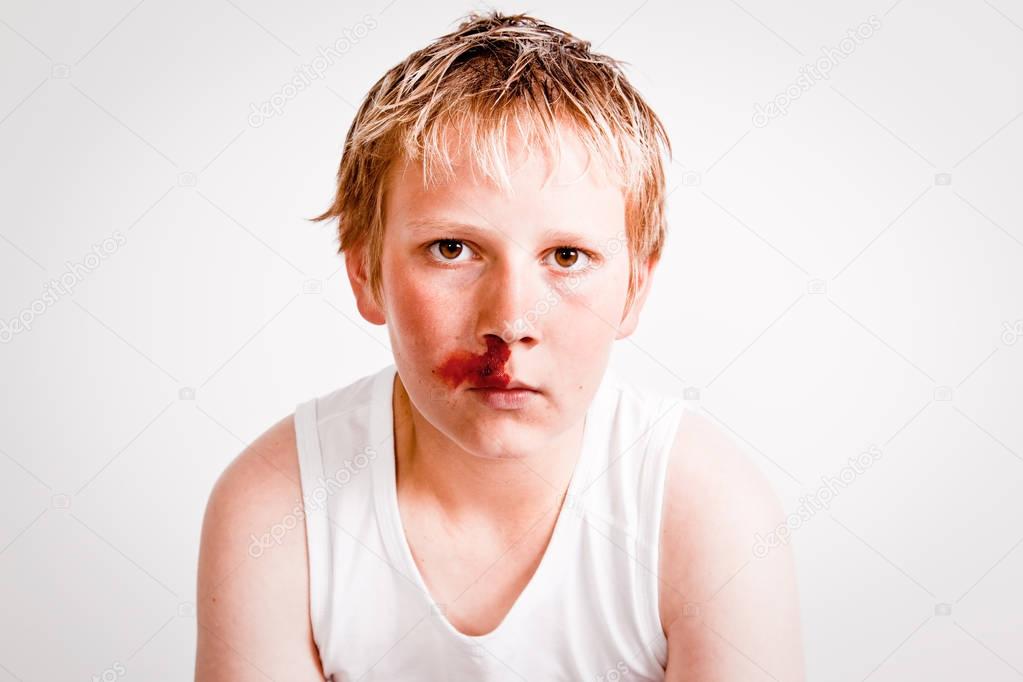 Teenage boy with a nosebleed