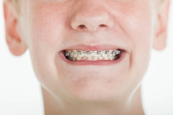 Young boy showing off his orthodontic braces — Stock Photo, Image