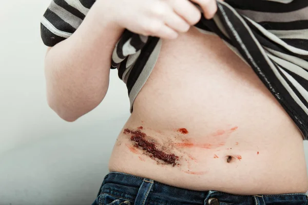 Νεαρό αγόρι με μια άσχημη πληγή στην κοιλιά — Φωτογραφία Αρχείου