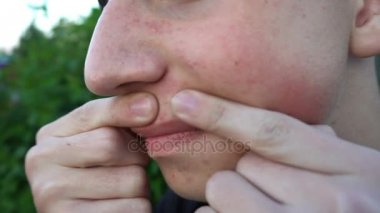 Genç adam presler bir sivilce, donuk cilt