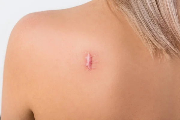 Keloid Scar Back Woman — Stock Photo, Image