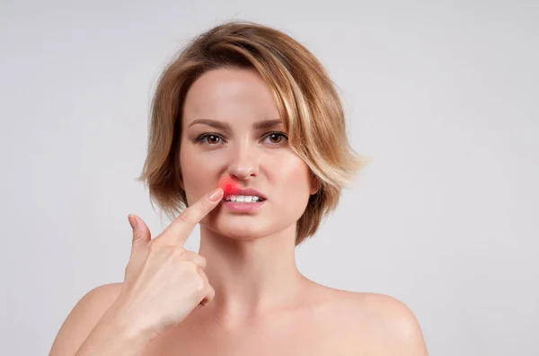 Acercamiento de los labios femeninos afectados por el virus del herpes — Foto de Stock