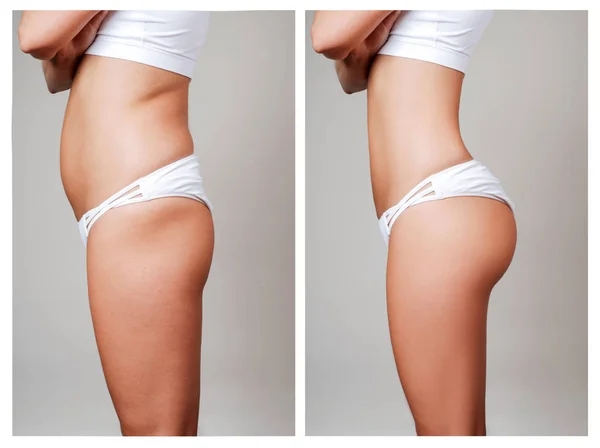 Kadın bedeninin işlemden önce ve sonra. Plastik cerrahi.