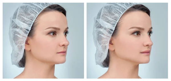 Retrato da face feminina, antes e depois da rinoplastia — Fotografia de Stock