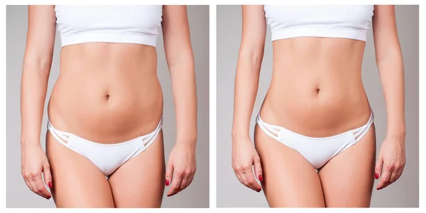 Kvinnliga kroppen före och efter behandling. Plastikkirurgi. — Stockfoto