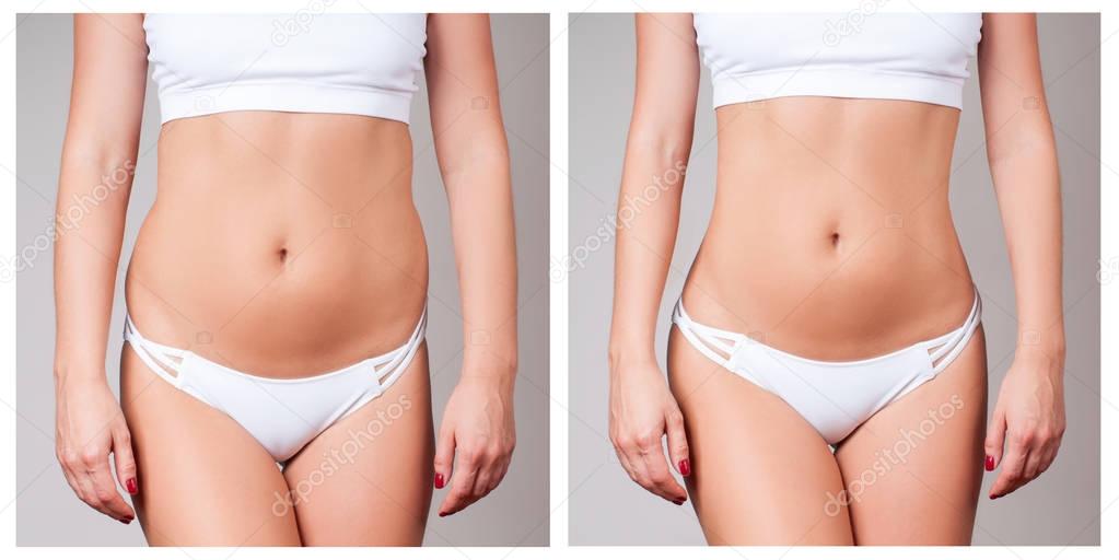 Female body before and after treatment. Plastic surgery.