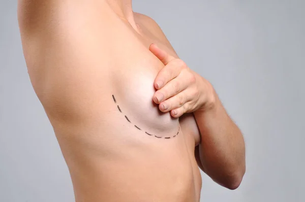 Cirugía plástica. Cuerpo desnudo. Pecho de mujer con líneas punteadas antes de la operación de aumento de pecho — Foto de Stock