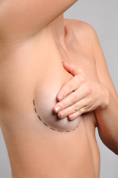 Plastic surgery. Naked body. Woman breast with dotted lines before breast augmentation operation