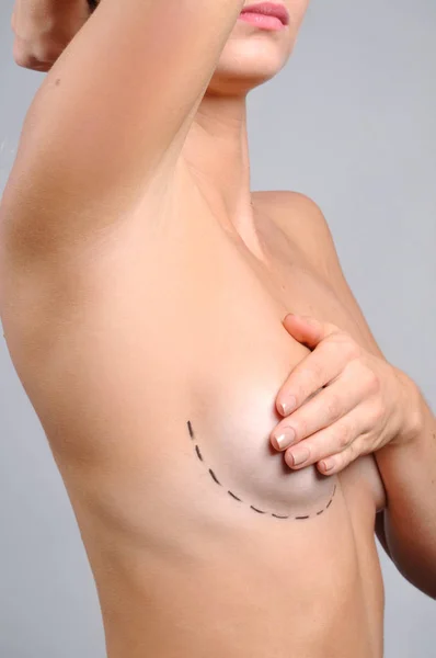 Plastic surgery. Naked body. Woman breast with dotted lines before breast augmentation operation