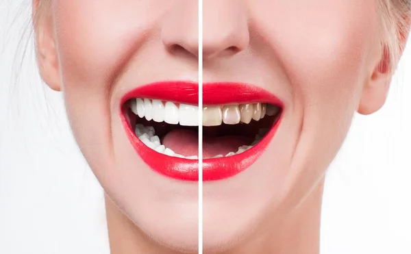 Sorriso feminino antes e depois do branqueamento. Branqueamento dos dentes . — Fotografia de Stock