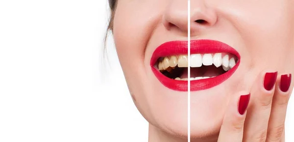 Sorriso feminino antes e depois do branqueamento. Branqueamento dos dentes . — Fotografia de Stock