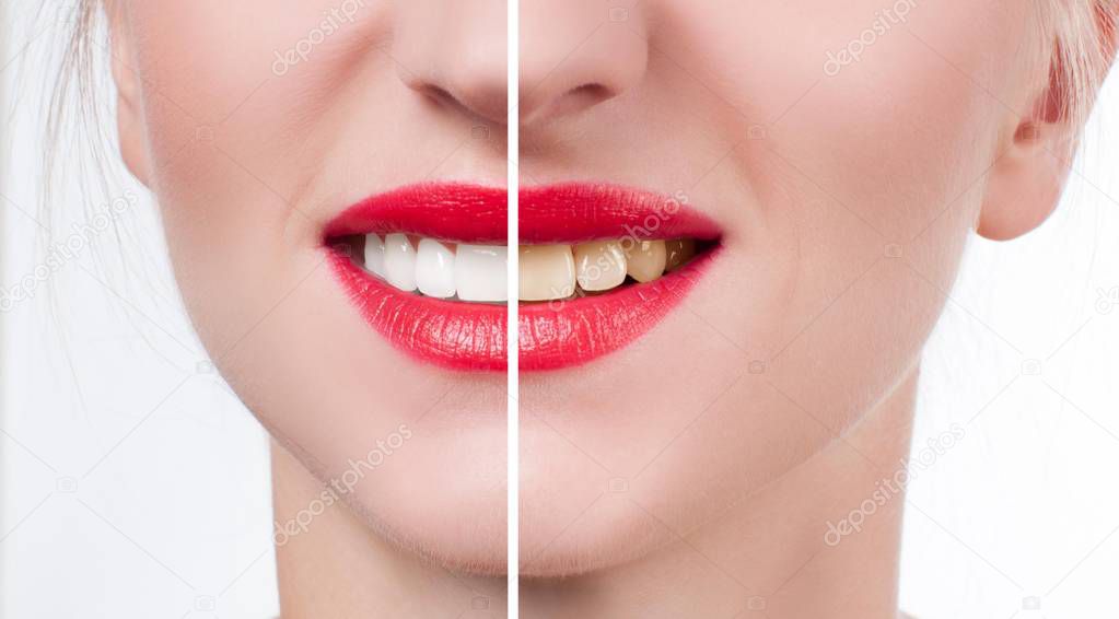 Female smile before and after bleaching. Whitening teeth.
