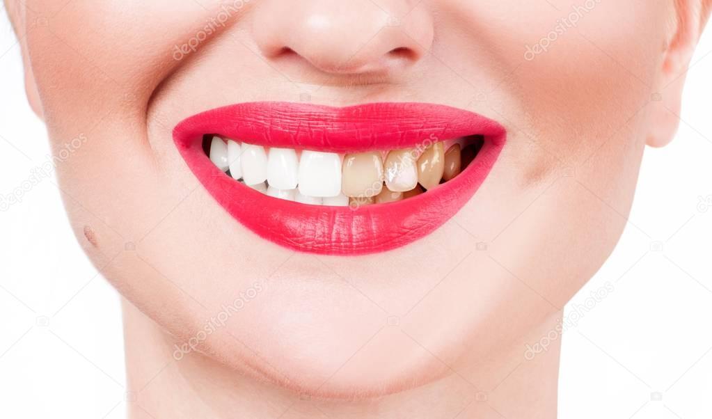Female smile before and after bleaching. Whitening teeth.