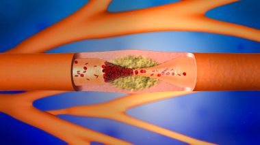 3d illustration of a precipitated and narrowing blood vessels or arteriosclerosis clipart