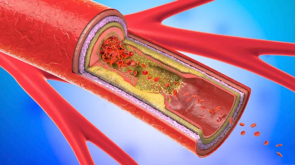 Ilustración Vasos Sanguíneos Precipitados Estrechos Arteriosclerosis — Foto de Stock