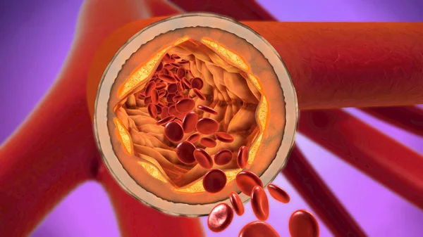 3d иллюстрация осадка и сужение кровеносных сосудов или — стоковое фото