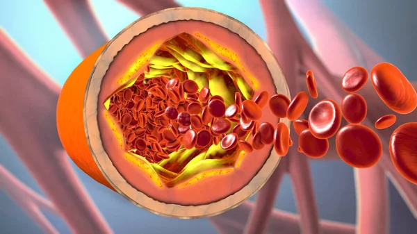 Vasos sanguíneos precipitados y estrechos o arteriosclerosis — Foto de Stock