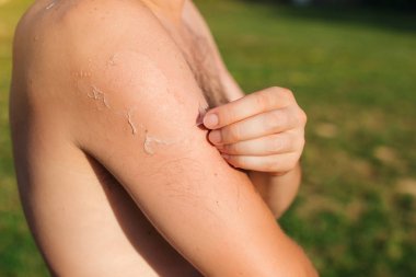 Adam sonra güneş yanığı ödemeyeceğiz üzerinde deri ile